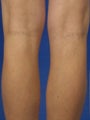 34 Year Old Patient Treated for Spider Veins