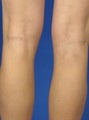 34 Year Old Patient Treated for Spider Veins