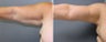 45 year old female sagging arm skin