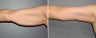 45 year old female sagging arm skin