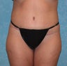 Circumferential Body Lift