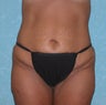 Circumferential Body Lift