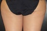 SmartLipo MPX