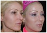 Before and After Sculptra