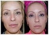 Before and After Sculptra