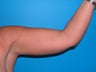 Liposuction arms on a 40 yr old woman