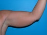 Liposuction arms on a 40 yr old woman