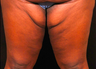 Thigh Lift