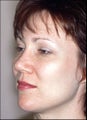 Rhinoplasty