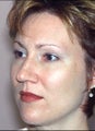 Rhinoplasty