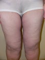 50 year old woman has Thigh Lift