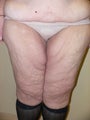 50 year old woman has Thigh Lift