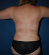 Liposuction back