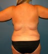 Liposuction back