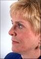 Rhinoplasty