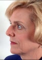 Rhinoplasty