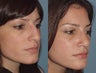 Female, Early 30's Looking to Minimize Bump
