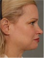 41 year old female with early jowls and neck laxity with excess volume. She doesn't want invasive surgery.