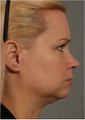 41 year old female with early jowls and neck laxity with excess volume. She doesn't want invasive surgery.