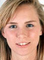 Rhinoplasty for a wide tip