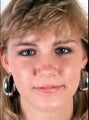 Rhinoplasty for a wide tip