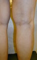 Varicose Vein Treatment Photographs