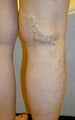 Varicose Vein Treatment Photographs