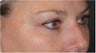 Restylane