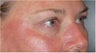 Restylane