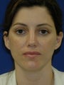 35 year old treated for Upper eyelid hollowing