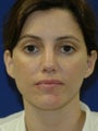 35 year old treated for Upper eyelid hollowing