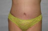 26 year old tummy tuck