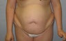 26 year old tummy tuck