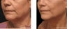 Evolastin Non-Surgical Neck Lift