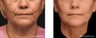 Evolastin Non-Surgical Neck Lift