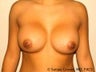 Breast Augmentation