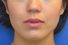 Buccal Fat Removal with Dysport (Botox) Jaw Slimming