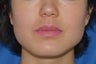 Buccal Fat Removal with Dysport (Botox) Jaw Slimming
