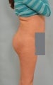 Buttock augmentation (BBL)