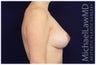 Breast lift