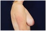 Breast lift