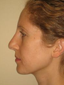 Nose Surgery