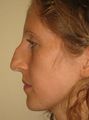 Nose Surgery