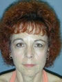 Brow Lift