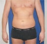 Laser Liposuction