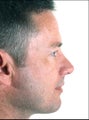 Rhinoplasty