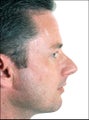 Rhinoplasty