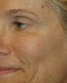 Dysport - The BOTOX Alternative