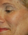 Dysport - The BOTOX Alternative