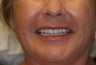 68 year old Female treated with All-on-4 Dental Implant Procedure
